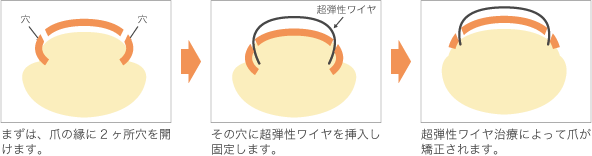 ingrownnail_2 ingrownnail_2